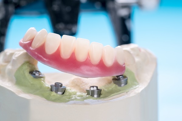 Rediscovering Chewing Comfort with Modern Dental Implants